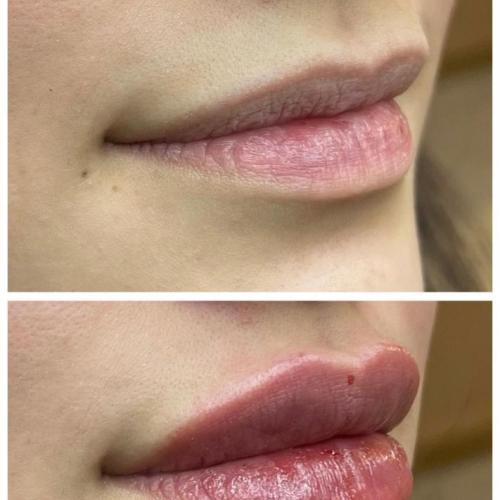 Botox Before / After photo